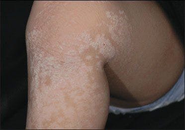 Can you identify the intensely itchy plaques on this girl’s leg?