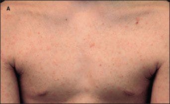 These 3 dermatologic disorders often have similar characteristics.  Can you tell which is which?
