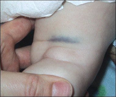 Unexplained Bruising: Weighing the Pros and Cons of Possible Causes