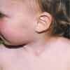 Branchial Cleft Cyst in an Infant