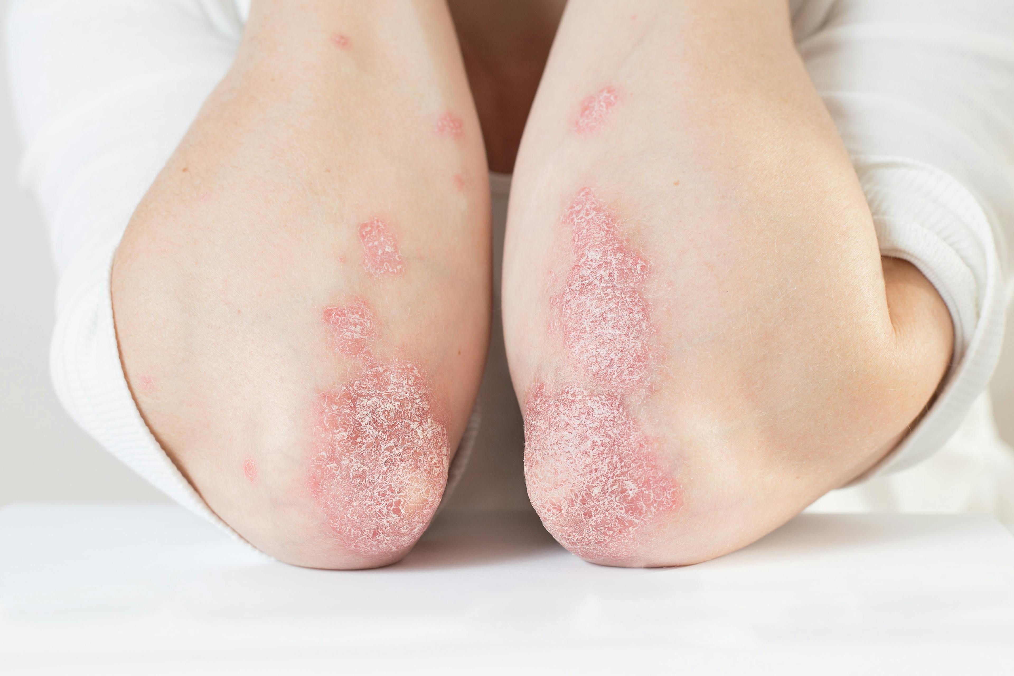 No risk of outpatient infections identified for pediatric psoriasis patients starting ustekinumab