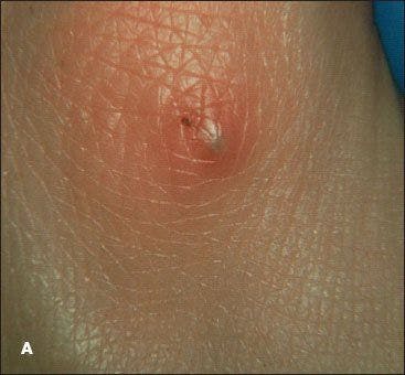 Lesions That Point to Serious Bacterial Infections