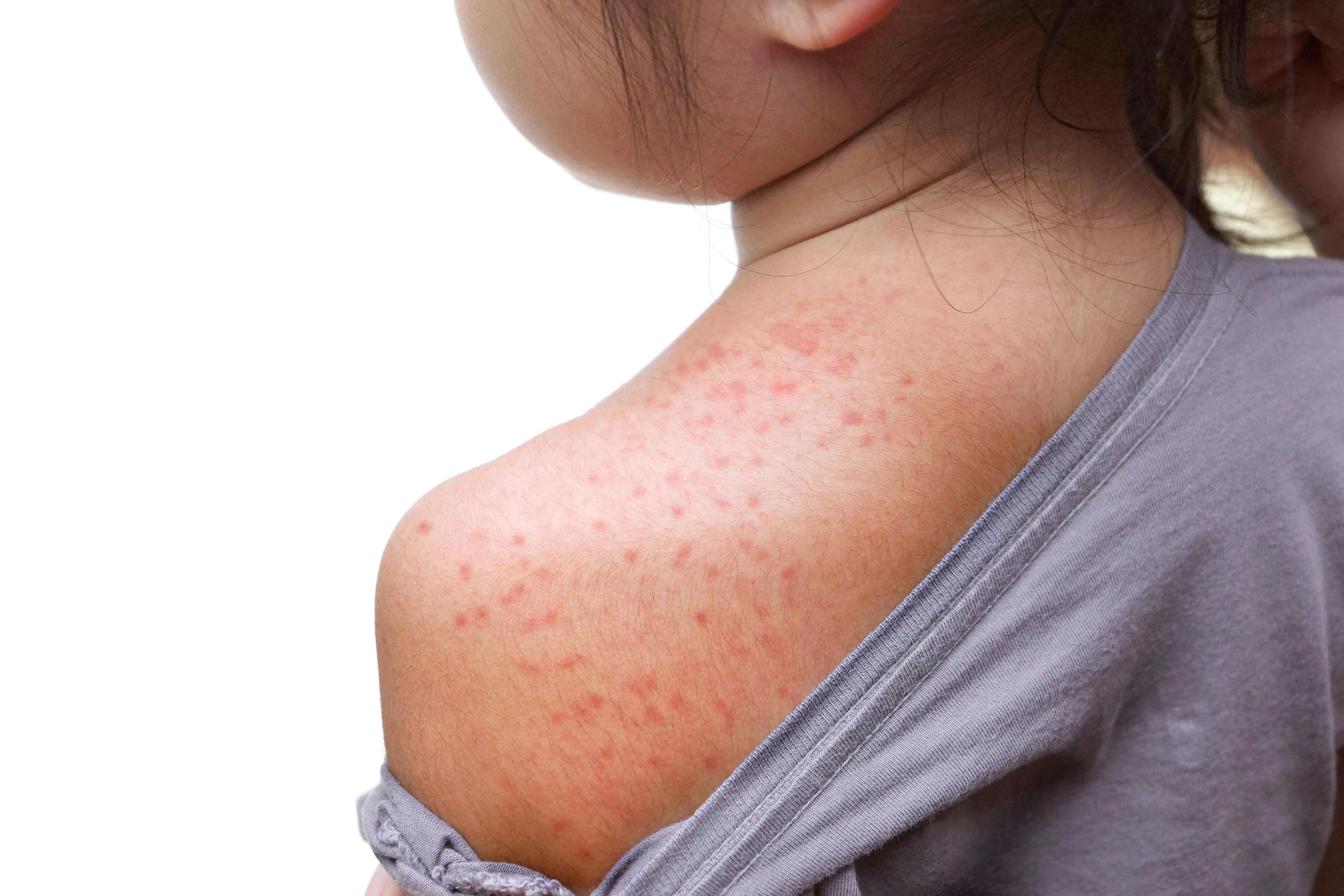 CDC issues health advisory amid increasing US, global measles cases |  Image Credit: © weerapat1003 - © weerapat1003 - stock.adobe.com.