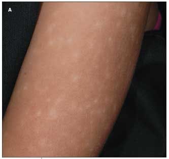 Are These New Erythematous Papules Related to the Patient's Hypopigmented Macules?