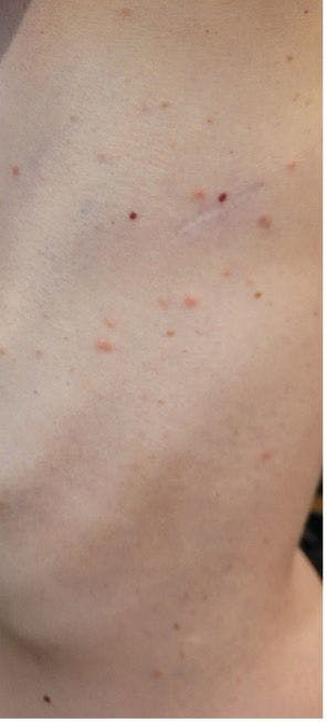 Young woman with tick bites presents with erythematous papules, headaches, and fatigue
